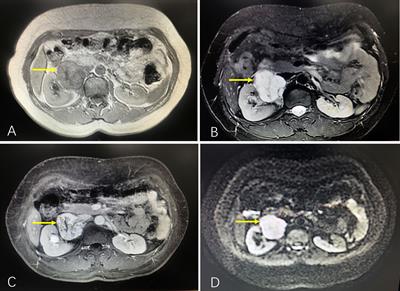 Case report: Capillary hemangioma in the renal hilum mimicking paraganglioma